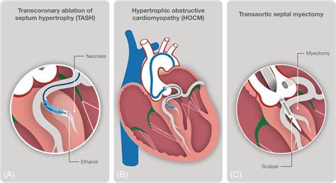 septal vein ablation diagram